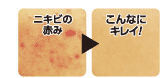 痘痘红了好美啊!